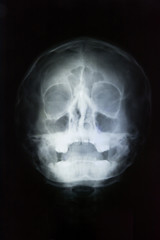 human skull head x-ray