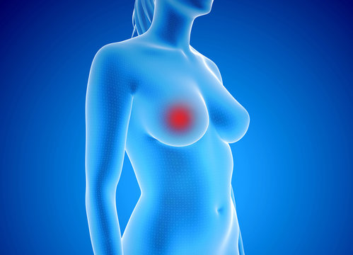 3d rendered illustration of breast cancer