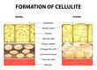 Formation of cellulite