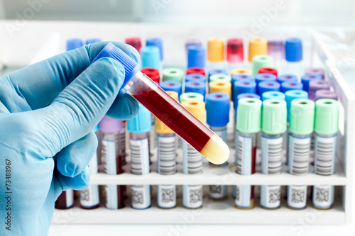 Cuadros en Lienzo Técnico de laboratorio que sostiene un tubo de ensayo de sangre