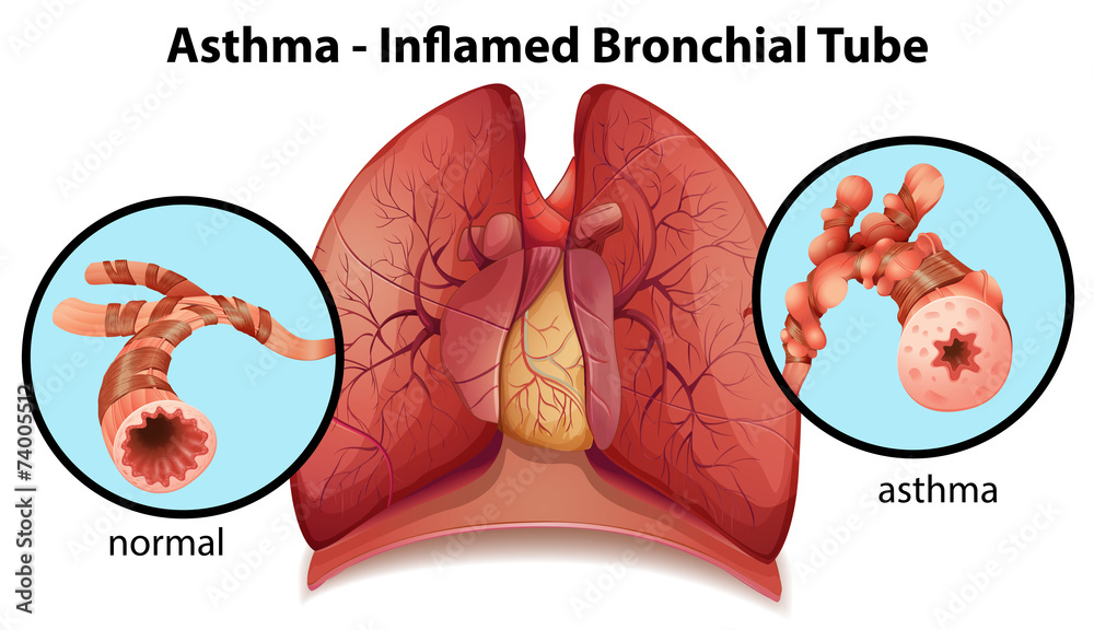 An asthma-inflamed bronchial tube - obrazy, fototapety, plakaty 