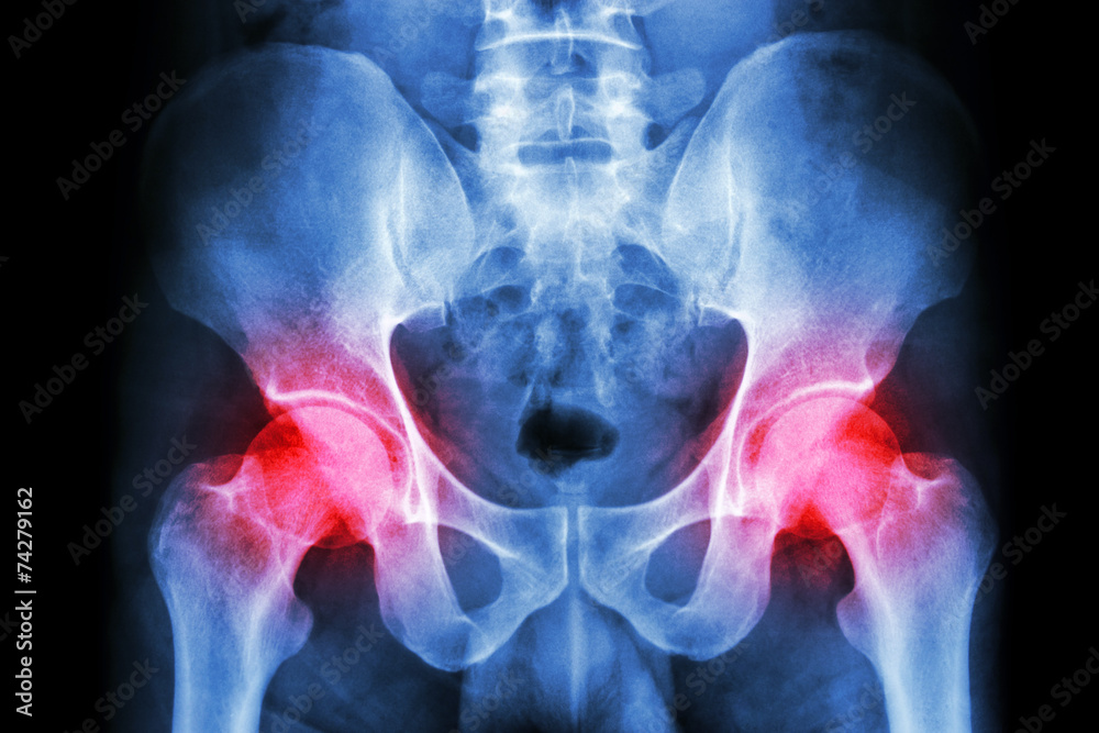 human's pelvis and arthritis at both hip joint (Gout,Rheumatoid) - obrazy, fototapety, plakaty 