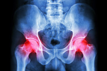 Human's Pelvis And Arthritis At Both Hip Joint (Gout,Rheumatoid)