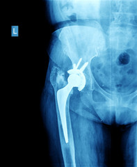 X-ray of the hip prosthesis