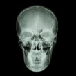 © stockdevil - X-ray skull and Stroke ( cerebrovascular accident (CVA) )
