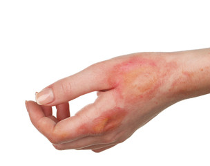 Horrible burns on female hand isolated on white