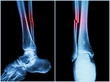 © stockdevil - Fracture shaft of fibula bone ( leg bone ) .  X-ray of leg