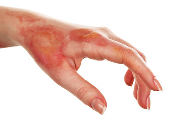 horrible burns on female hand isolated on white