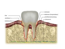 Bakterielle Entzündung Am Zahnfleisch