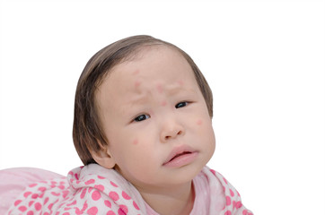 Asian girl with mosquito bites spot on face