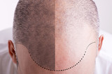 Fototapeta Panele - Hair Loss - Before and After