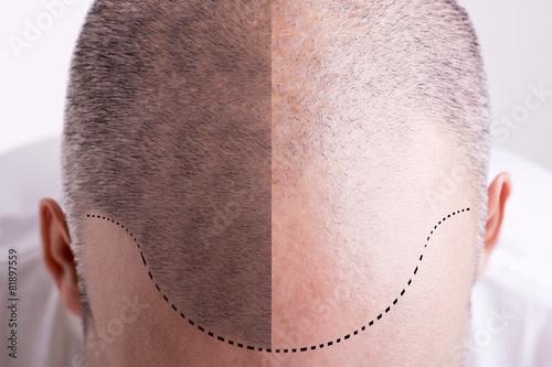 Hair Loss - Before and After