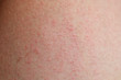  allergic rash dermatitis skin of patient