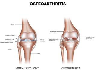 Wall Mural - Knee Osteoarthritis