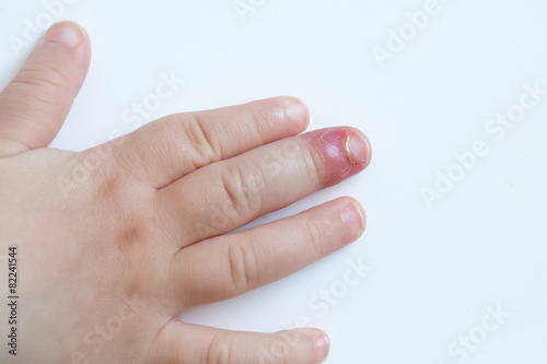 Fotografie, Obraz Fingernail bed inflammation, bacterial infection