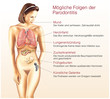 © Henrie - Mögliche Folgen der Parodontitis