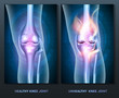 Normal knee and unhealthy abstract burning knee joint