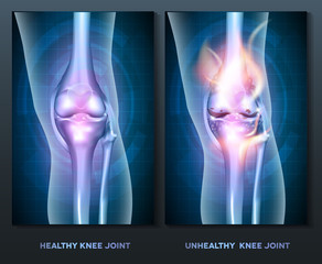 Poster - Normal knee and unhealthy abstract burning knee joint