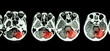 Stroke  ( CT scan of brain and base of skull and Stroke )