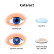 © designua - A cataract is an clouding crystalline lens