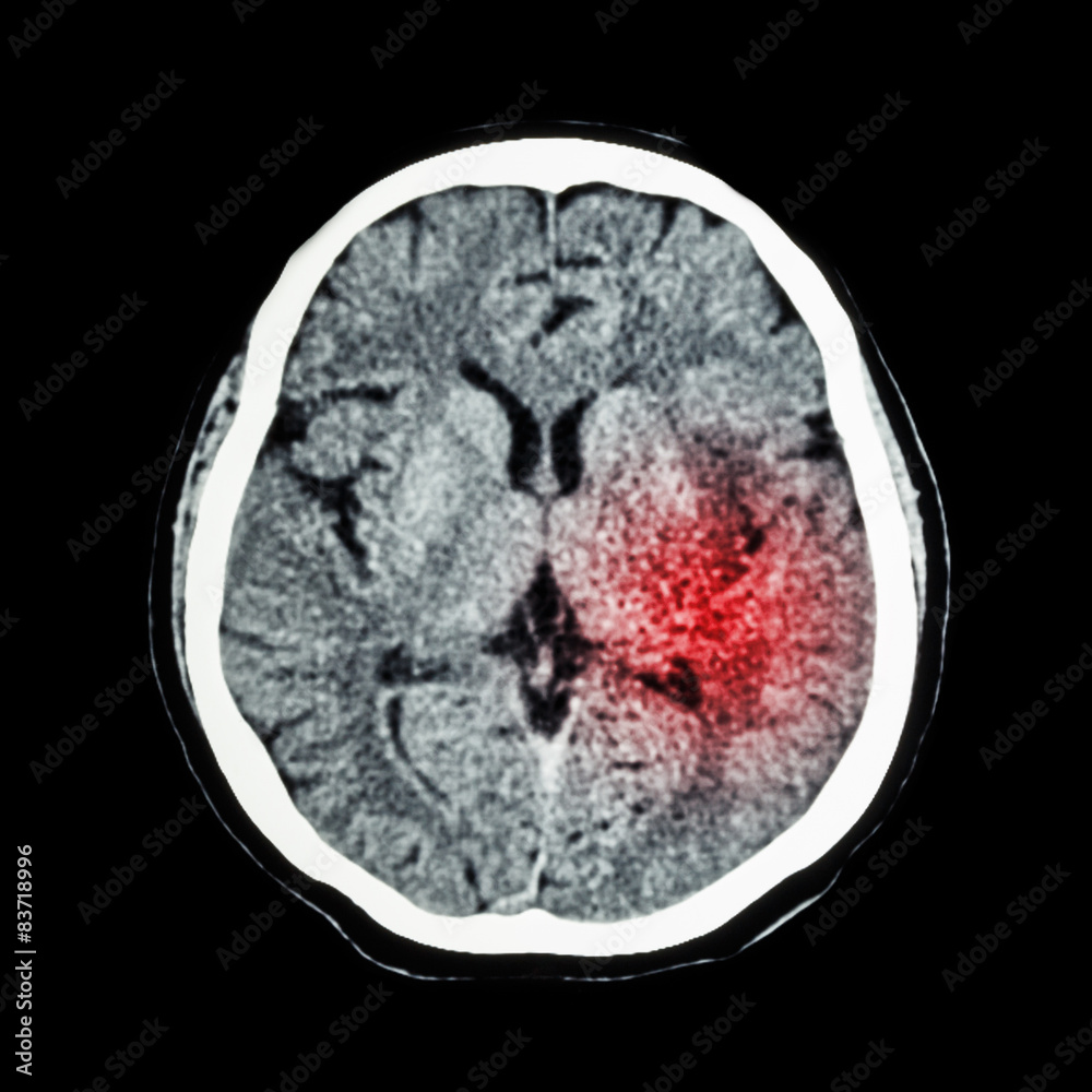 CT scan of brain show Ischemic Stroke or Hemorrhagic Stroke Stock Photo ...