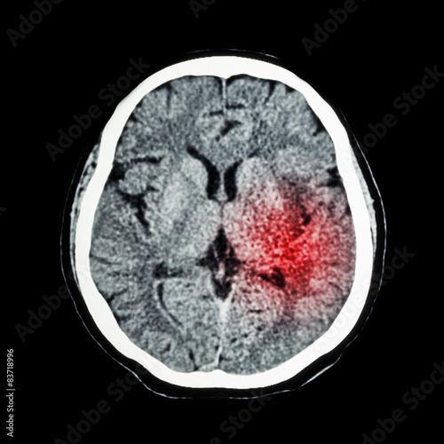 Fotografie, Obraz CT scan of brain show Ischemic Stroke or Hemorrhagic Stroke