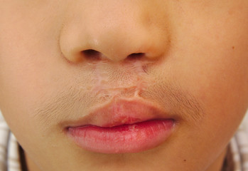 Boy showing a bilateral cleft lip repaired.