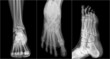 collection of human foot ankel