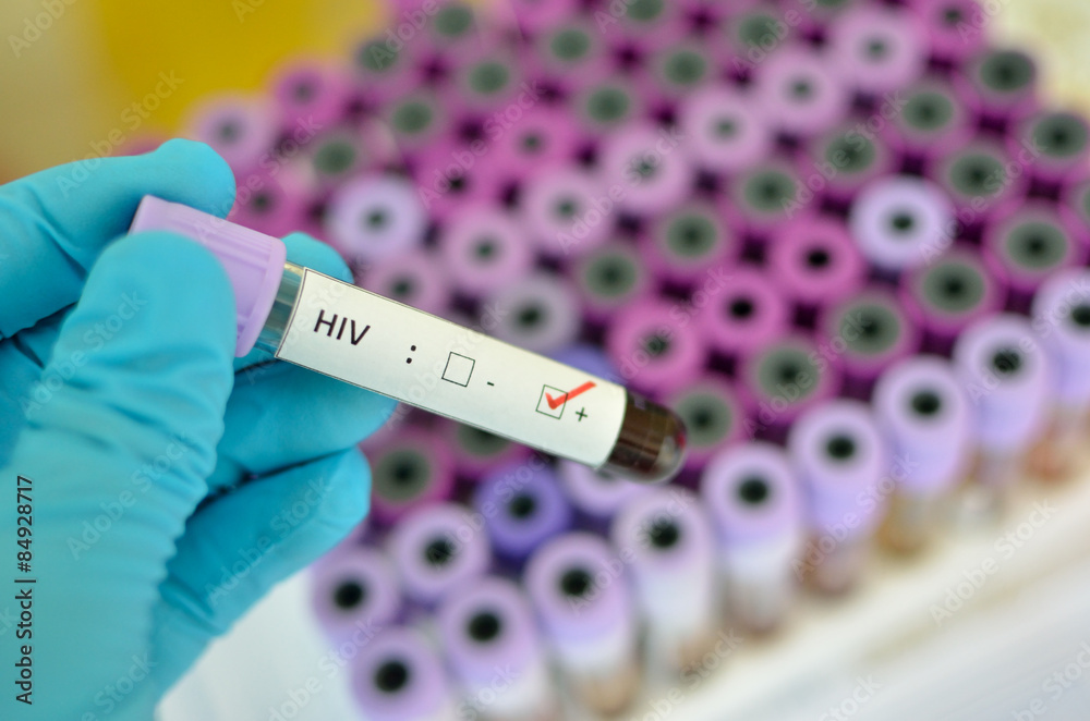 Blood sample with HIV positive - obrazy, fototapety, plakaty 