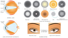 Eye Disease Cataract