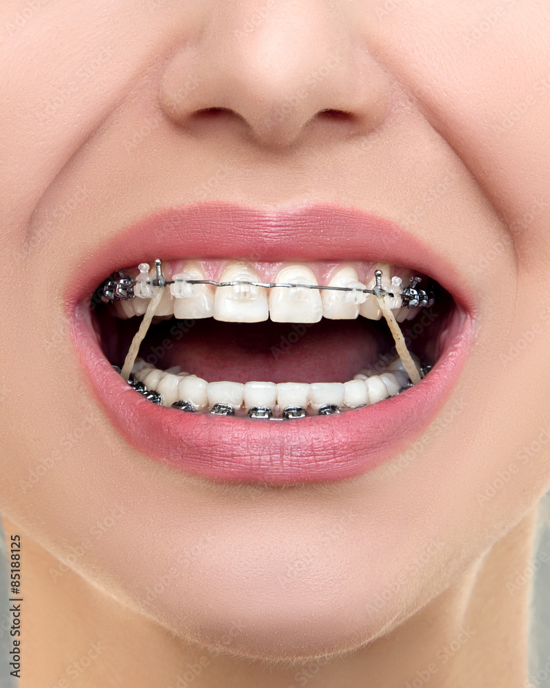 Elastic bands for teeth discount