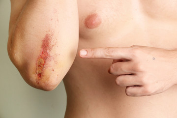 Wall Mural - man pointing his finger at wounded elbow