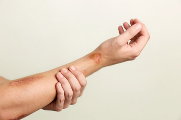 Wall Mural - close up view of nasty wounds on man's arm