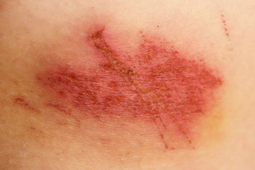 Wall Mural - close up view of nasty wounds