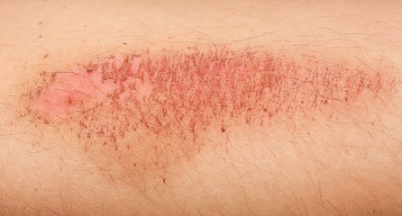 Wall Mural - close up view of nasty wounds