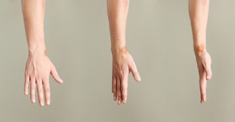 close up view of nasty wounds on wrist from different angles
