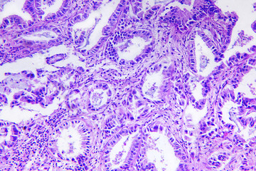 Well differentiated adenocarcinoma of a human