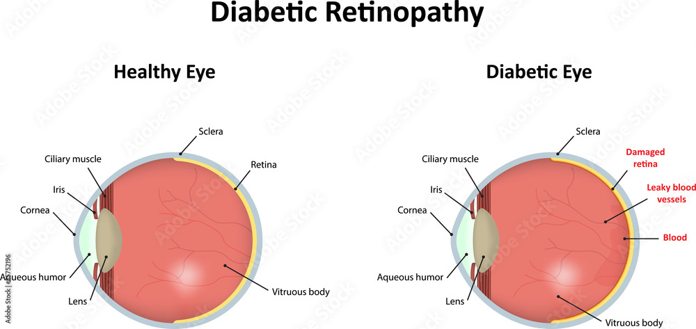 Diabetic Retinopathy Stock Vector | Adobe Stock