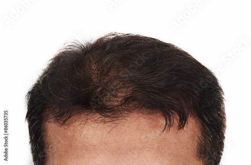 Hair Loss Male Head With Hair Loss Symptoms Front Side Buy This