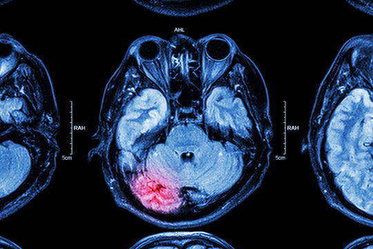Fototapete - MRI of brain : brain injury