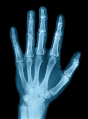 Scanned real x-ray film image of a men's hand. Toned version.