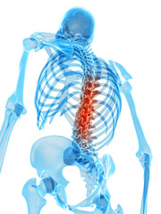 medically accurate illustration - painful back