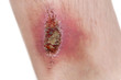 wounded leg in white background