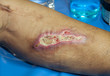 Inflammation wound at leg of diabetes patient