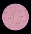 © toeytoey - fresh red blood cells in urine specimen under microscope 400x.