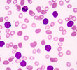 Acute lymphoblastic leukemia(ALL)