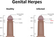 Genital Herpes Illustration