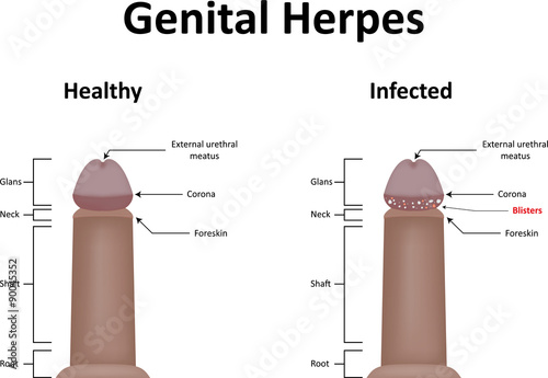 Long Tongue Caressing Cock Genital Herpes On Penis