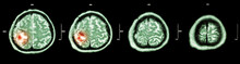 Brain Tumor  ( Film CT-scan Of Brain : Show Part Of Brain With Tumor )