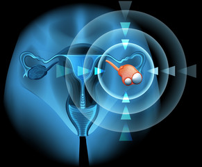 Sticker - Ovarian diagram with focus